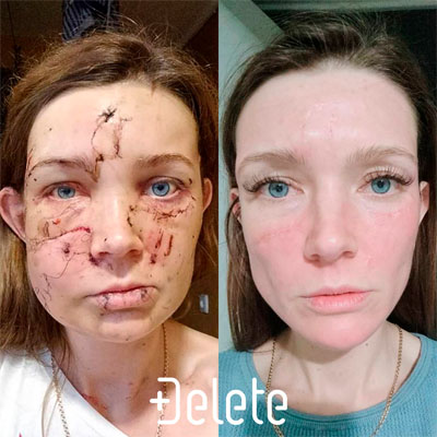 Видалення шрамів