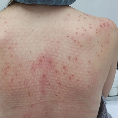 Результат видалення пігментації. Фото 2