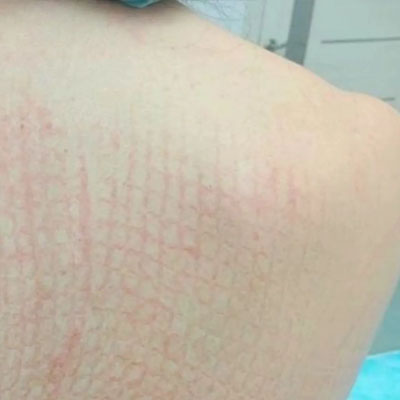 Результат видалення пігментації. Фото 3