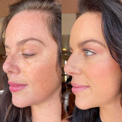 Результат видалення пігментації. Фото 4