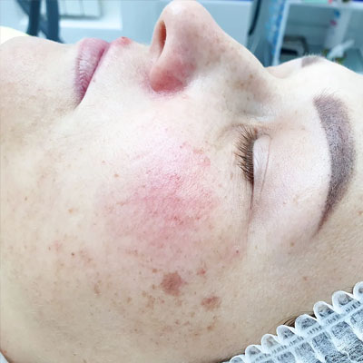 Результат видалення пігментації. Фото 5