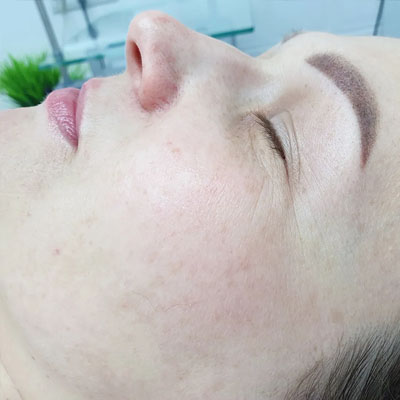 Результат видалення пігментації. Фото 6