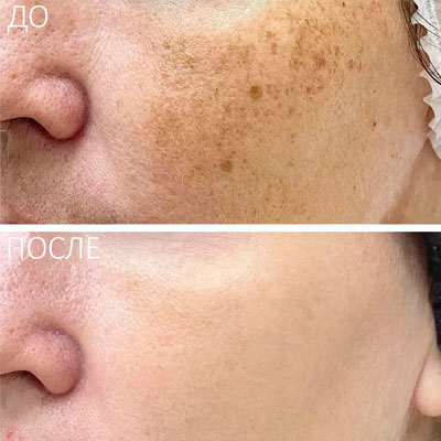 Результат видалення пігментації. Фото 8