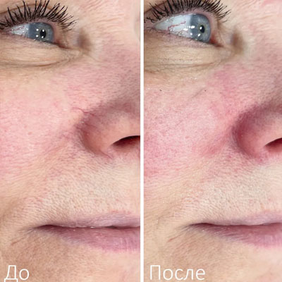 Результат видалення пігментації. Фото 9