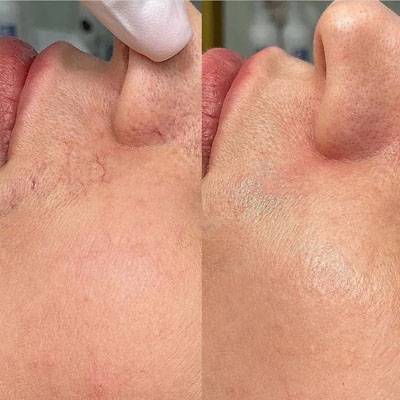 Результат видалення пігментації. Фото 10