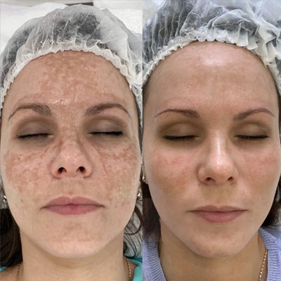 Результат видалення пігментації. Фото 7