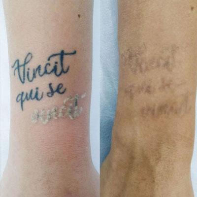 Видалення тату 1