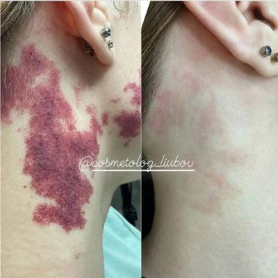 Результат видалення пігментації. Фото 11