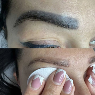 Удаление тату