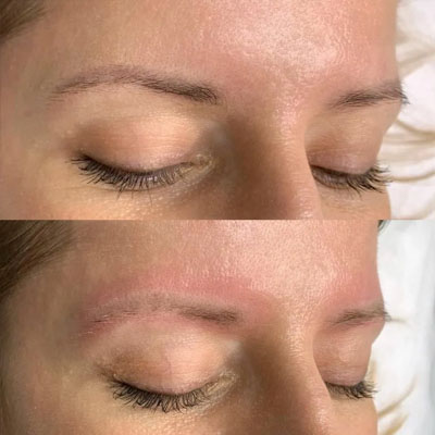 Видалення тату. Фото 1