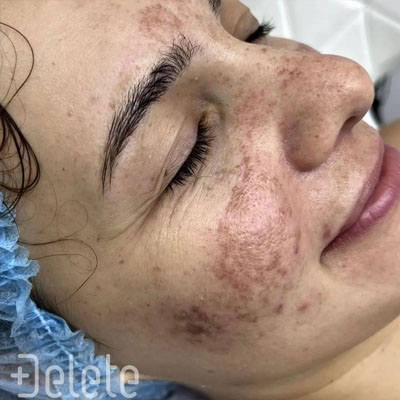 Пігментація до процедури