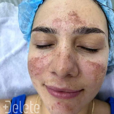 Пігментація до процедури. Фото 2