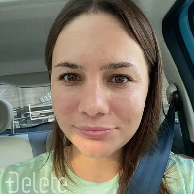 Результат видалення пігментації