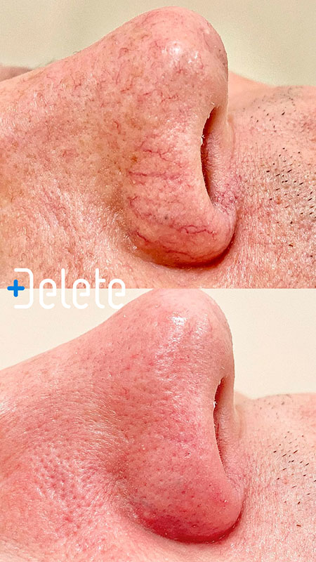 Лазерна епіляція, фото 2