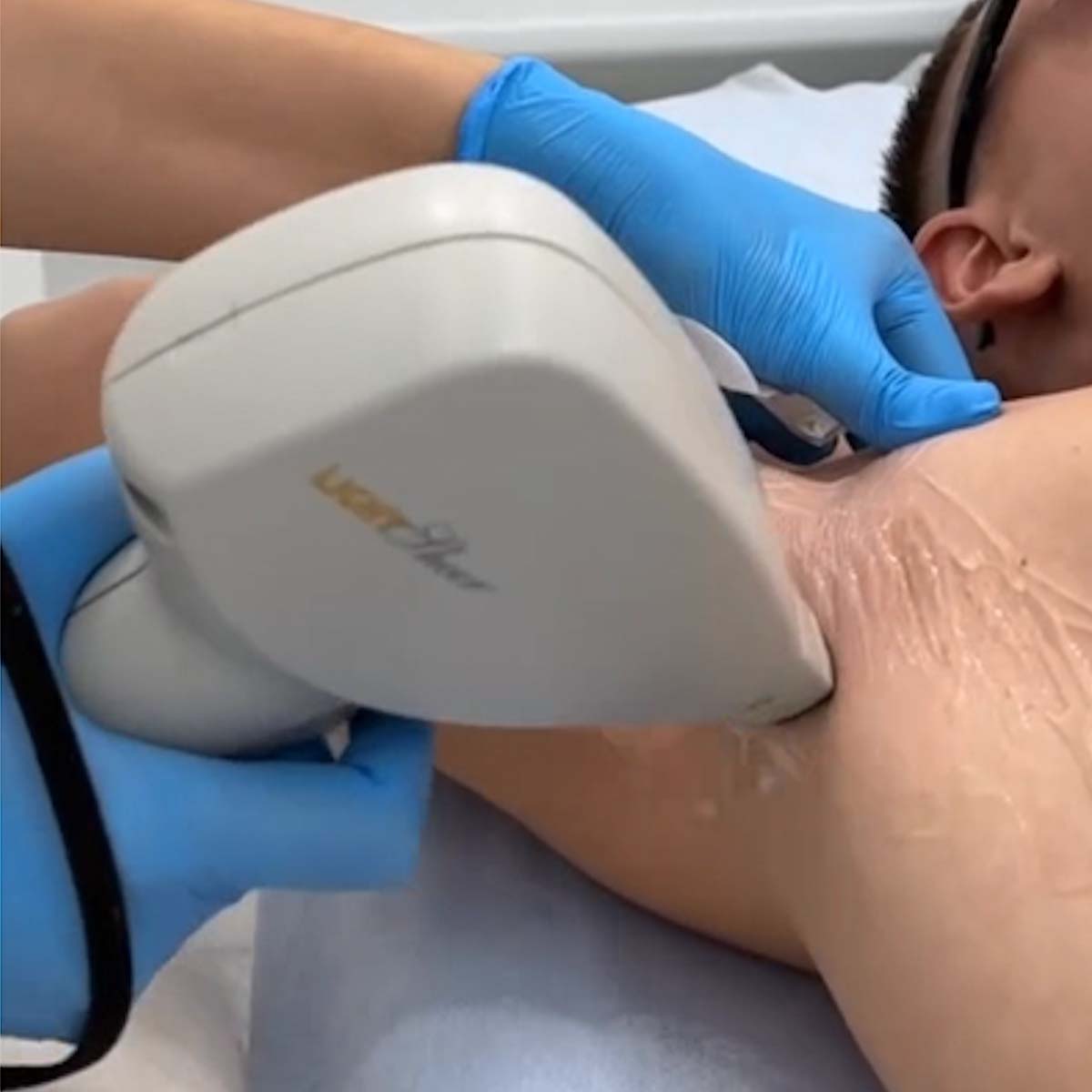 Лазерна епіляція