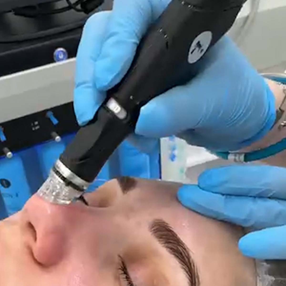 Чистка обличчя Hydrafacial