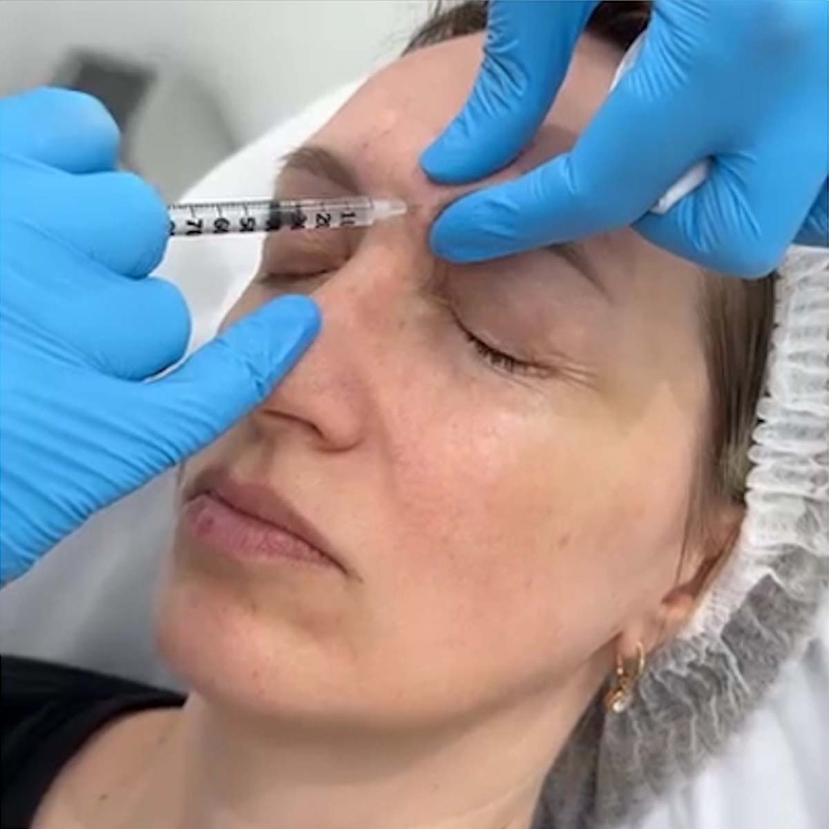 Ботулінотерапія