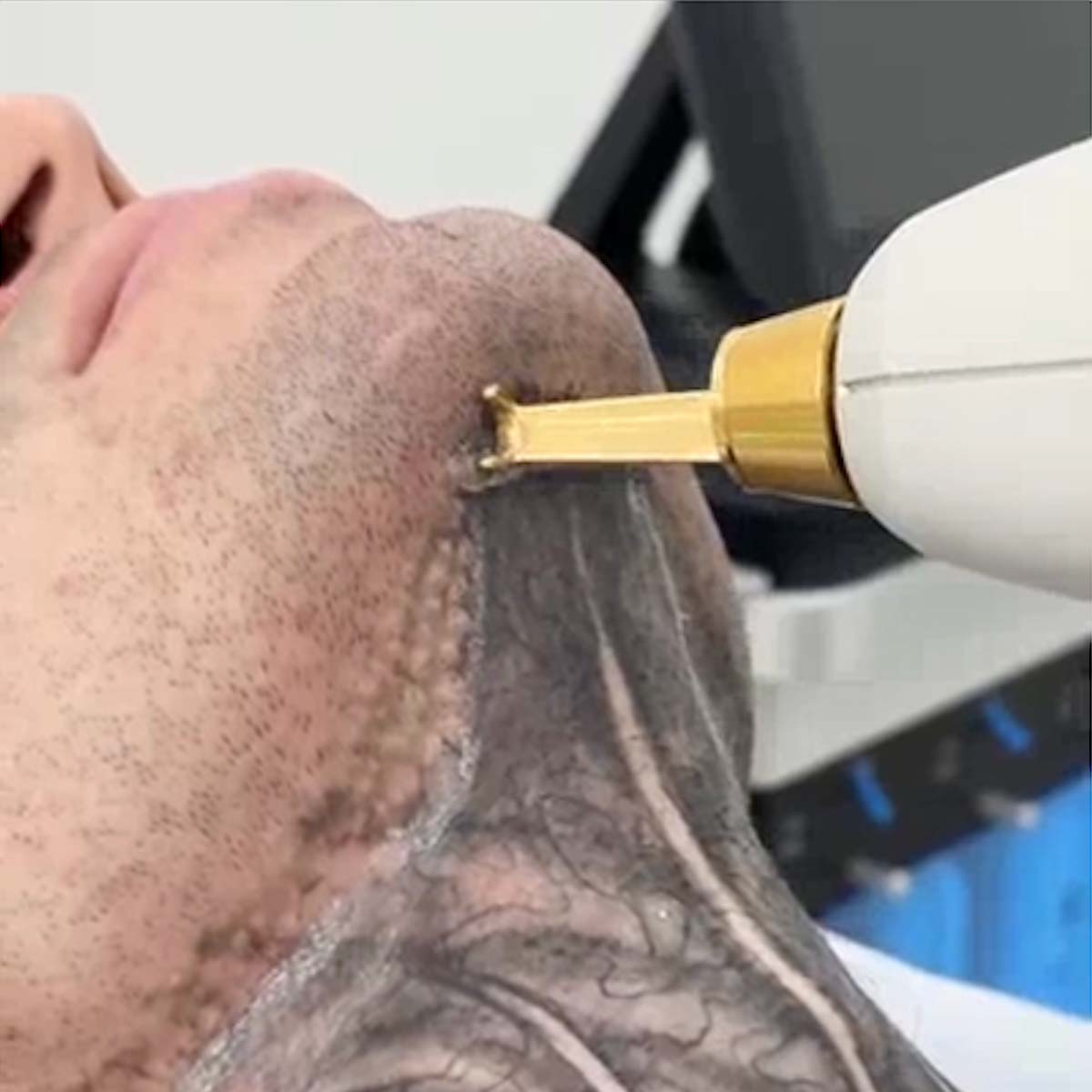 Видалення тату